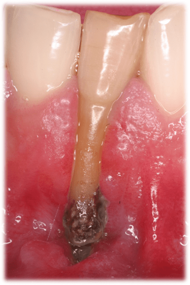 Consideraciones Diagnósticas Orientadas al Tratamiento de las Deformidades y Condiciones Mucogingivales